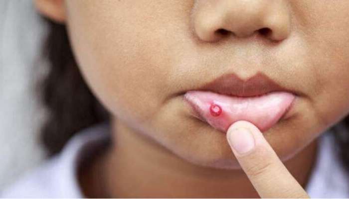 Mouth Ulcer: വായ്പുണ്ണ് ഭേദമാകാൻ ചില പൊടികൈകൾ 