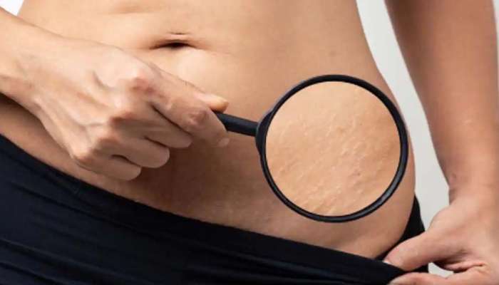 Stretch Mark Treatment : പ്രസവ ശേഷം സ്‌ട്രെച് മാർക്കുകൾ മാറ്റാൻ ചെയ്യേണ്ടതെന്ത്?