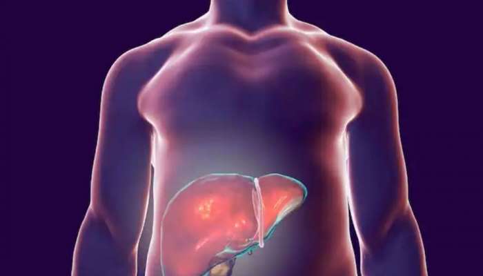 Fatty Liver: 35 ശതമാനം ഇന്ത്യക്കാർ ഫാറ്റി ലിവർ രോ​ഗികളെന്ന് പഠനം; ഈ ലക്ഷണങ്ങൾ അവ​ഗണിക്കരുത്