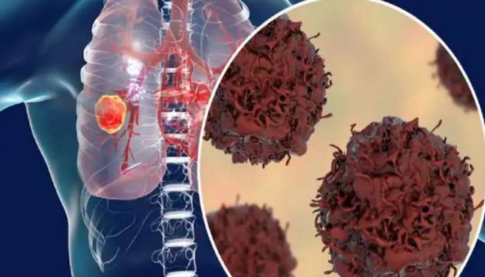 Lung Cancer: ശ്വാസകോശ അർബുദം: കൃത്യസമയത്ത് കണ്ടെത്തി പ്രതിരോധിക്കാം; പരിശോധനയും ചികിത്സയും സംബന്ധിച്ച് അറിയേണ്ട കാര്യങ്ങൾ