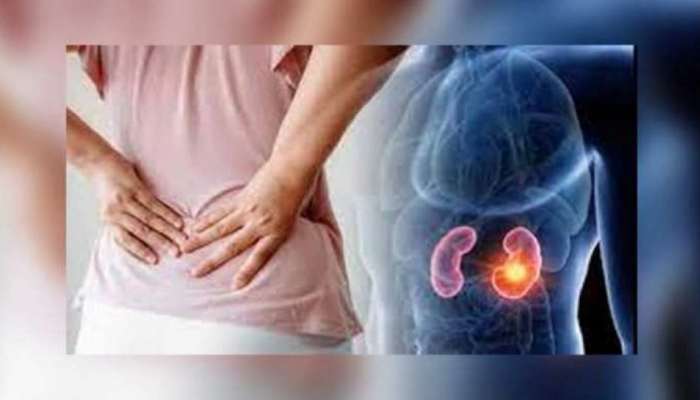 Kidney Stone: കിഡ്നി സ്റ്റോൺ; ഈ ലക്ഷണങ്ങളെ നിസാരമായി കാണരുത്!