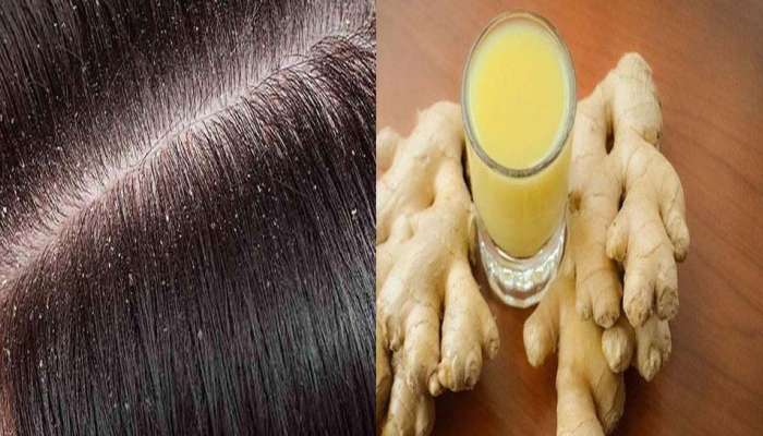 Dandruff Remedy : താരന്റെ ശല്യം കൂടുന്നുണ്ടോ? ഈ വിദ്യയൊന്ന് പരീക്ഷിച്ച് നോക്കൂ 