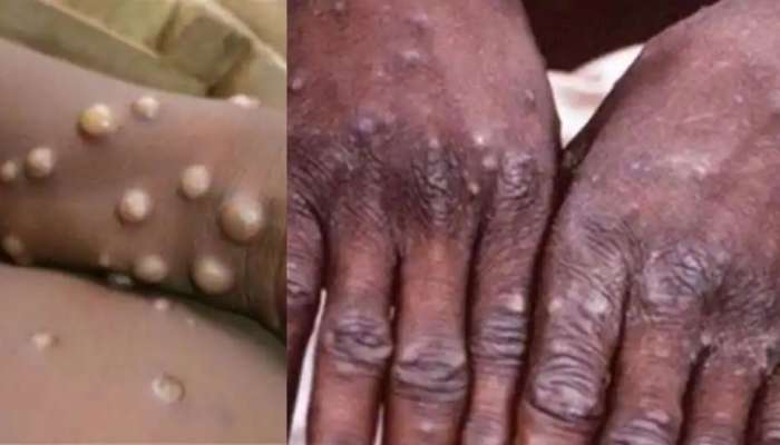 Monkeypox: കുരങ്ങ് പനി വ്യാപിക്കുന്നു; യുകെയിൽ മൂന്നാഴ്ച ക്വാറന്റൈൻ