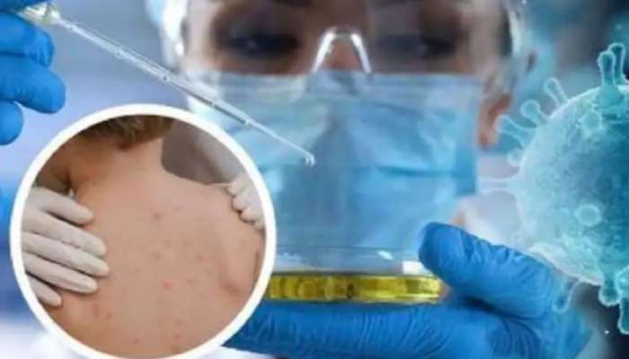 Monkeypox: മങ്കിപോക്സ് വ്യാപനം തടയാൻ ഇക്കാര്യങ്ങൾ ശ്രദ്ധിക്കണം; നിർദേശങ്ങളുമായി ലോകാരോ​ഗ്യ സംഘടന