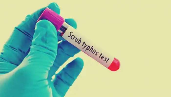 Scrub typhus: സ്‌ക്രബ് ടൈഫസ് അഥവാ ചെള്ളുപനി എന്താണ്, പകരുന്നതെങ്ങനെ; കാരണങ്ങളും ലക്ഷണങ്ങളും പ്രതിരോധവും അറിയാം