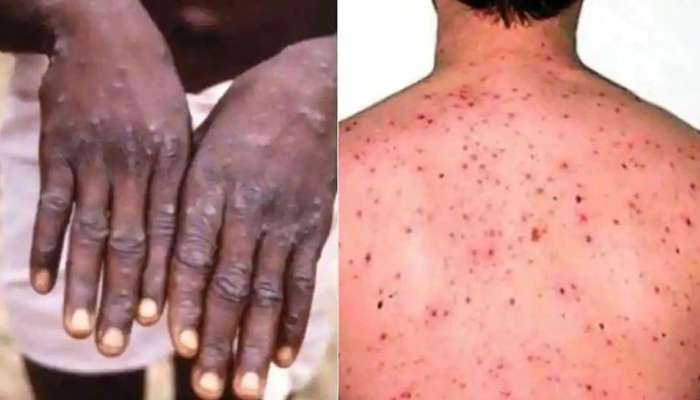 Monkey Pox Mutation: വാനര വസൂരി വൈറസിന് പ്രതീക്ഷിച്ചതിൽ കൂടുതൽ ജനിതക വകഭേദങ്ങളെന്ന് പഠനം