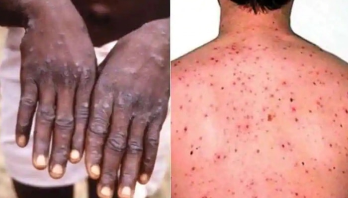 Monkeypox: കേരളത്തിൽ മങ്കി പോക്സ് സ്ഥിരീകരിച്ചു; റിപ്പോർട്ട് ചെയ്തത് ഇന്ത്യയിലെ ആദ്യത്തെ കേസ്