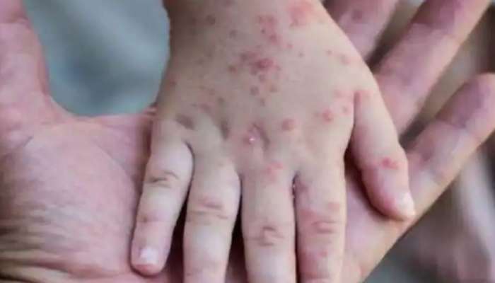 Monkeypox Kerala: മങ്കിപോക്‌സ് ഐസൊലേഷനും ചികിത്സയ്ക്കുമുള്ള മാർ​ഗനിർദേശങ്ങൾ പുറത്തിറക്കിയതായി മന്ത്രി വീണാ ജോര്‍ജ്