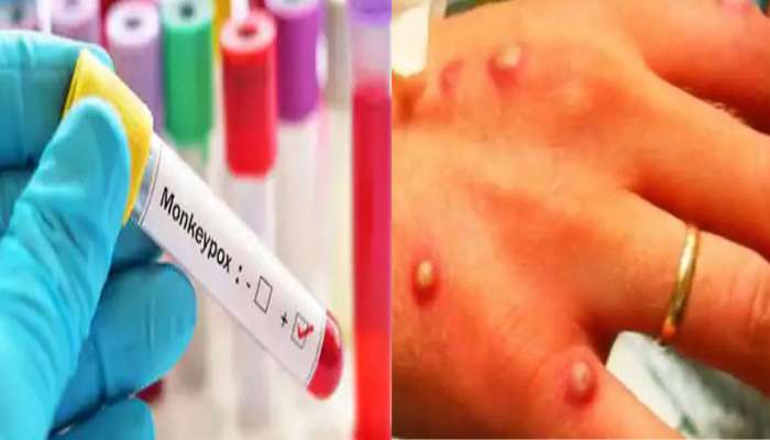 Kerala Monkeypox Virus: കേരളത്തില്‍ റിപ്പോര്‍ട്ട് ചെയ്ത മങ്കിപോക്സിന് തീവ്രവ്യാപന ശേഷിയില്ല