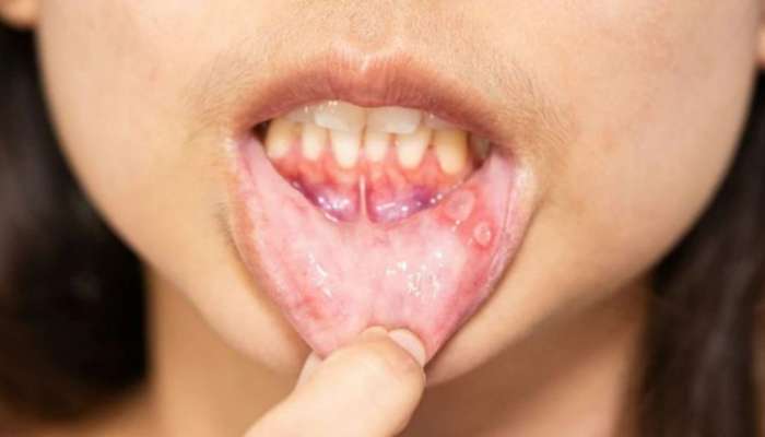 Mouth Ulcers: വായിലെ അൾസറിനെ പ്രതിരോധിക്കാൻ അ‍ഞ്ച് പ്രകൃതിദത്ത മാർ​ഗങ്ങൾ വീട്ടിൽ തന്നെ ചെയ്യാം