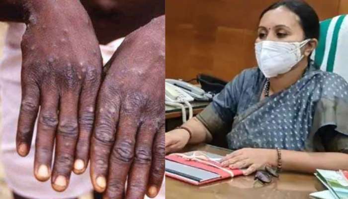 Monkeypox :ആദ്യ രോഗി രോഗമുക്തി നേടി; ഇന്ന് ഡിസ്ചാര്‍ജ് ചെയ്യും