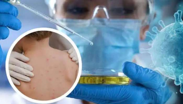 Monkeypox: സ്പെയിനിൽ ആദ്യ മങ്കിപോക്സ് മരണം റിപ്പോർട്ട് ചെയ്തു; മങ്കിപോക്സ് ​ഗുരുതരമാകുന്നോ? ഭയക്കേണ്ടതുണ്ടോ?