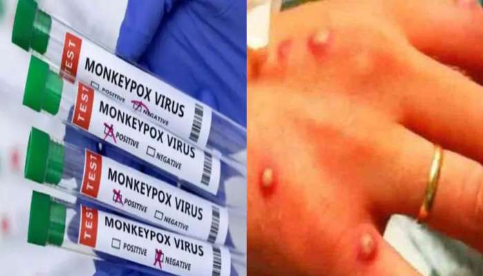 Monkeypox In Delhi: ഡൽഹിയിൽ ഒരാൾക്ക് കൂടി മങ്കിപോക്സ്‌ സ്ഥിരീകരിച്ചു