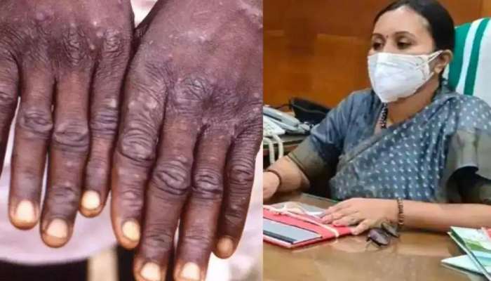 Monkey Pox: സംസ്ഥാനത്ത് ഒരാള്‍ക്ക് കൂടി മങ്കിപോക്‌സ് സ്ഥിരീകരിച്ചു: മന്ത്രി വീണാ ജോര്‍ജ്