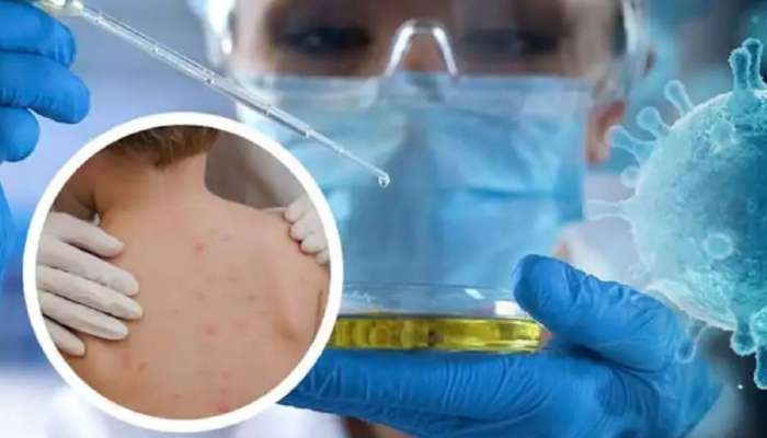 Monkeypox Delhi: ഡൽഹിയിൽ മൂന്നാമത്തെ മങ്കിപോക്സ് കേസ് റിപ്പോർട്ട് ചെയ്തു; രാജ്യത്ത് ആകെ മങ്കിപോക്സ് കേസ് എട്ടായി