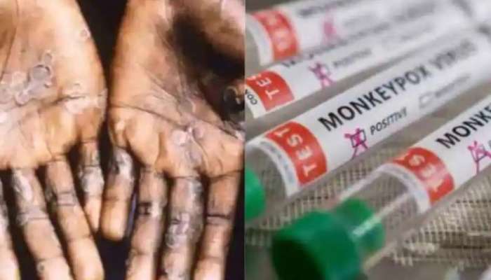 Monkeypox Update: സംസ്ഥാനത്തെ രണ്ടാമത്തെ രോഗിയും സുഖപ്പെട്ടു, ശനിയാഴ്ച ഡിസ്ചാര്‍ജ്