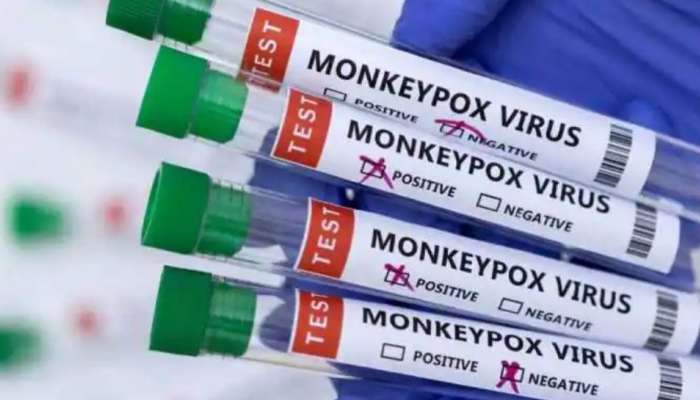 Monkeypox: മങ്കിപോക്സ് ലക്ഷണങ്ങൾ; കണ്ണൂരിൽ ഏഴ് വയസുകാരി നിരീക്ഷണത്തിൽ
