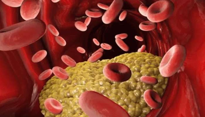 Cholesterol: ഉയർന്ന കൊളസ്ട്രോൾ കൊണ്ട് കഷ്ടപ്പെടുന്നോ? ഇതാ കൊളസ്ട്രോൾ കുറയ്ക്കാനുള്ള വഴികൾ