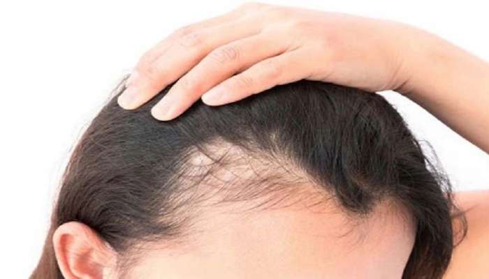 Hair loss treatment try these Ayurvedic remedies to get rid of hairfall | Hair  Fall Ayurvedic Remedies: മുടി കൊഴിച്ചില്‍ ഇല്ലാതാകും, ഈ ആയുർവേദ  നുറുങ്ങുകള്‍ പരീക്ഷിക്കൂ| News in Malayalam