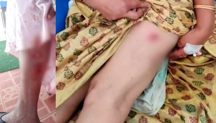 Stray dog attack: ഇടുക്കിയിൽ തെരുവുനായയുടെ ആക്രമണം; വയോധിക ഉൾപ്പടെ ഏഴ് പേർക്ക് കടിയേറ്റു