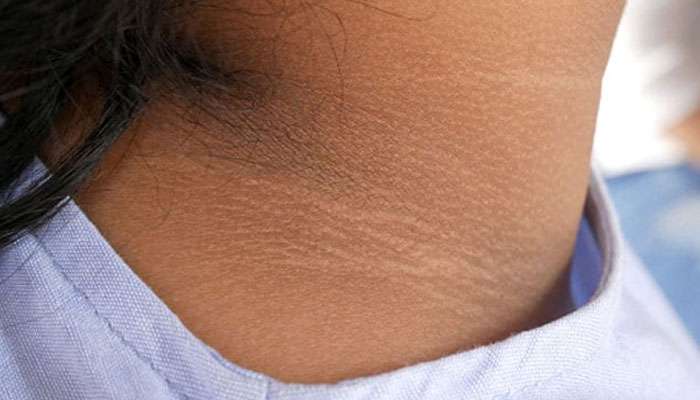 Dark Neck Remedy: കഴുത്തിലെ കറുപ്പ് നിങ്ങളെ അലട്ടുന്നുണ്ടോ? ഈ വീട്ടുവൈദ്യങ്ങൾ പിന്തുടരൂ, ഫലം ഉറപ്പ്!