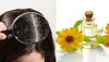 Dandruff Remedies: മുടിയിൽ എണ്ണ തേക്കുന്നത് താരൻ വർദ്ധിപ്പിക്കുമോ? 