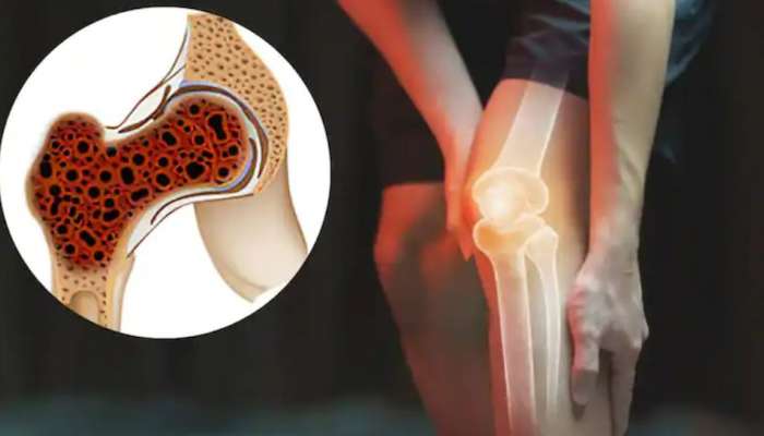 Bone Cancer Symptoms: ബോൺ കാൻസർ; അവ​ഗണിക്കരുത് ഈ ലക്ഷണങ്ങൾ