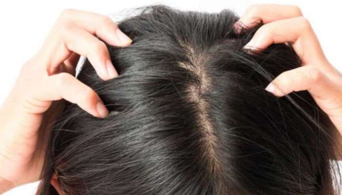 Dandruff: ശൈത്യകാലത്ത് താരൻ ശല്യം രൂക്ഷമാകുന്നോ? ഈ വീട്ടുവൈദ്യങ്ങൾ പരീക്ഷിക്കാം
