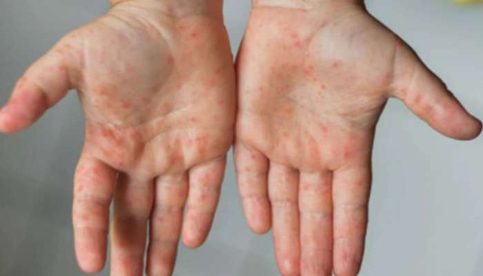 Measles outbreak in Mumbai: അഞ്ചാം പനി പടരുന്നു; സുരക്ഷിതരായിരിക്കാൻ ഇക്കാര്യങ്ങൾ ശ്രദ്ധിക്കൂ