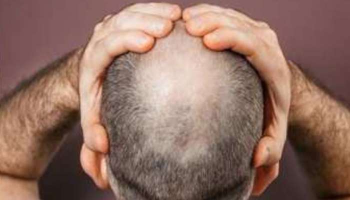 Hair Transplant: ഹെയർ ഫിക്സിങ്ങിന് വിധേയനായ യുവാവിന് ആന്തരികാവയവങ്ങൾ തകരാറിലായി ദാരുണാന്ത്യം