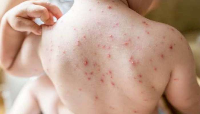  Measles Outbreak : അഞ്ചാം പനി വ്യാപകമാകുന്നു; മലപ്പുറം ജില്ലയിലെ വിദ്യാഭ്യാസ സ്ഥാപനങ്ങളിലും അംഗൻവാടികളിലും മാസ്ക് നിർബന്ധമാക്കി 