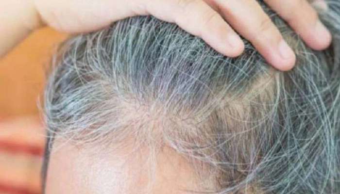 Hair Fall Solution: മുടി കൊഴിച്ചിലിനും നരയ്ക്കും പരിഹാരം, ഈ അടുക്കള നുറുങ്ങുകള്‍ പരീക്ഷിക്കാം 