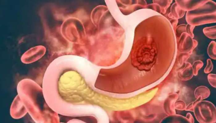 Gastric Cancer: വിവിധ തരത്തിലുള്ള ആമാശയ കാൻസറുകളും ലക്ഷണങ്ങളും