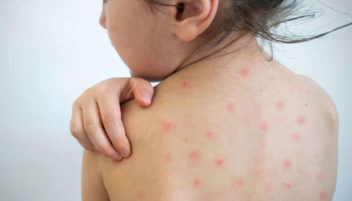 Measles outbreak: കോഴിക്കോട് നാദാപുരത്ത് അഞ്ചാംപനി പടരുന്നു; ആകെ കേസുകൾ 32 ആയി, വാക്സിൻ സ്വീകരിക്കാൻ വിമുഖത കാണിച്ച് ജനങ്ങൾ