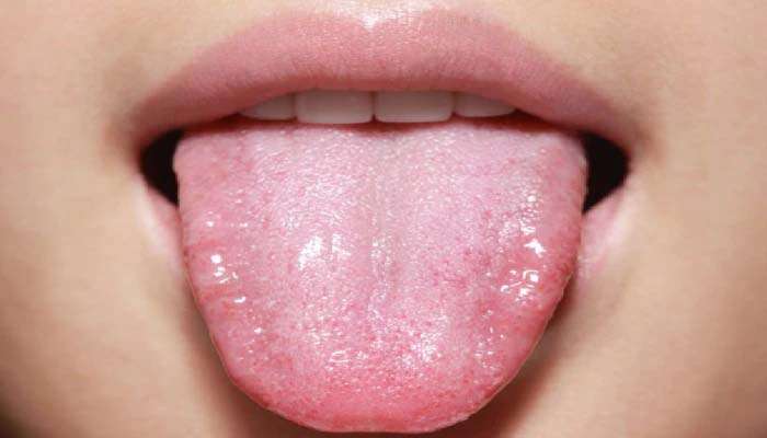 Tongue Color: നാവ് പറയും നിങ്ങളുടെ ആരോഗ്യം 