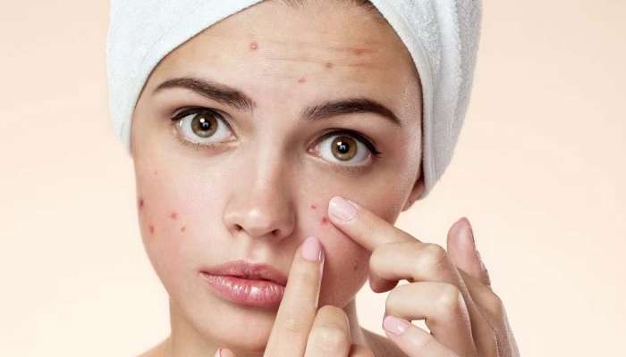 Pimple Easy Remedies : മുഖക്കുരു അതിവേഗം മാറ്റാൻ ചില എളുപ്പവഴികൾ