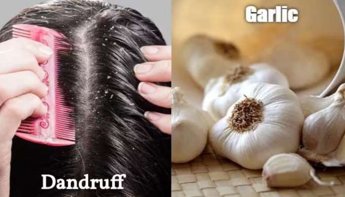 Hair Care: വെളുത്തുള്ളി നീര്, സുന്ദരമായ മുടിയ്ക്കുള്ള അത്ഭുത ടോണിക്ക്  