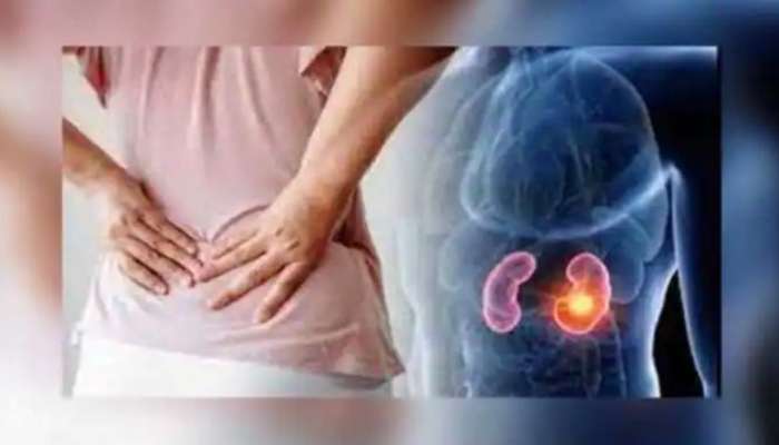 Kidney Stone: വൃക്കയിലെ കല്ലുകൾ; വേദന കുറയ്ക്കാൻ വീട്ടുവൈദ്യങ്ങൾ പരീക്ഷിക്കാം