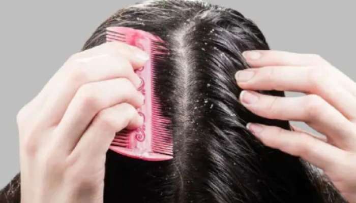 Dandruff remedies: താരനെ തുരത്താൻ വീട്ടിൽ തന്നെയുണ്ട് പരിഹാരങ്ങൾ