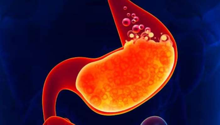 Acidity: അസിഡിറ്റിയെ തടയാം ലളിതമായ ഈ ഭക്ഷണശീലങ്ങളിലൂടെ