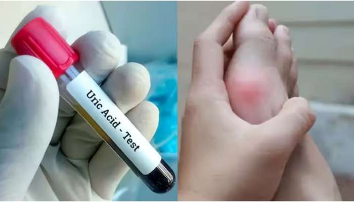 Uric acid: യൂറിക് ആസിഡിന്റെ അളവ് കൂടിയാൽ പ്രശ്നമാണോ? ഈ തെറ്റുകൾ ആവർത്തിക്കരുത്!