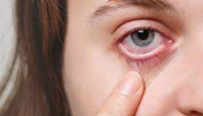 Eye Care Tips in Summer: വേനലിൽ കണ്ണുകൾക്ക് നൽകാം "സ്പെഷൽ കെയർ"; ഇവ ശീലമാക്കൂ