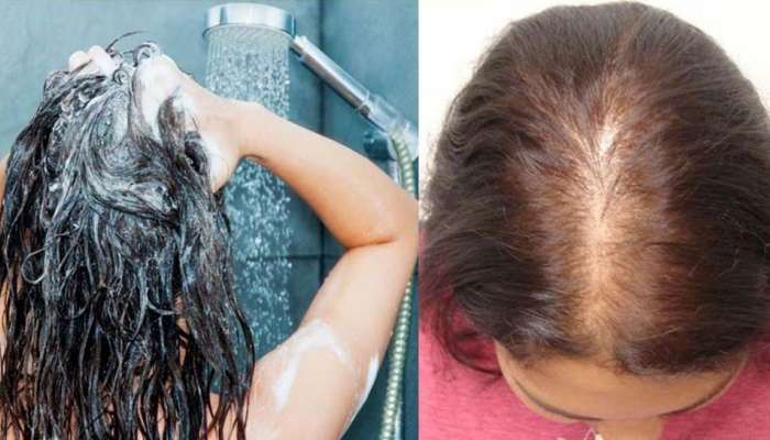 Baldness and Hair Fall: കഷണ്ടിയുടെ ഇരയാണോ? ഷാംപൂ ചെയ്യുമ്പോൾ ഇക്കാര്യങ്ങള്‍ ശ്രദ്ധിക്കുക 