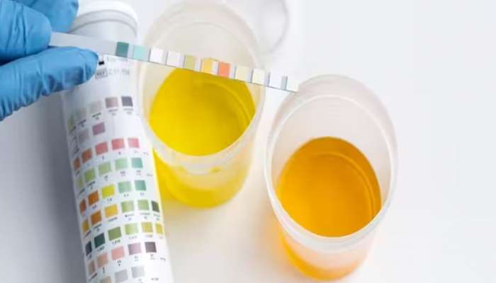 High Uric Acid Levels: യൂറിക് ആസിഡിന്റെ അളവ് ഉയരുന്നത് ​ഗുരുതര ആരോ​ഗ്യ പ്രശ്നങ്ങളിലേക്ക് നയിക്കും; ഈ പച്ചക്കറികൾ ആരോ​ഗ്യത്തിന് ഉത്തമം