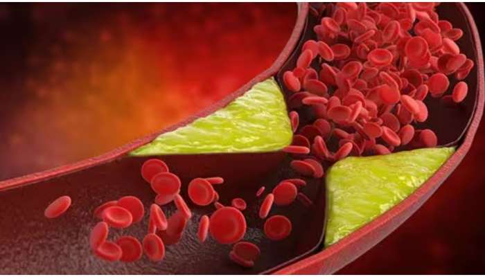 Bad Cholesterol: ശരീരത്തിലെ ചീത്ത കൊളസ്‌ട്രോൾ കുറയ്ക്കണോ? ഡയറ്റിൽ ഇവ ഉൾപ്പെടുത്തൂ