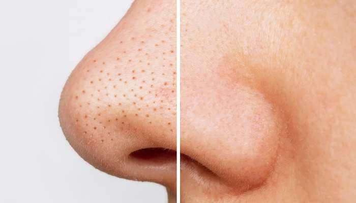 Blackheads Solution: ബ്ലാക്ക്‌ഹെഡ്‌സ് എളുപ്പത്തില്‍ നീക്കം ചെയ്യാം, ഈ മാസ്‌ക് പരീക്ഷിക്കൂ 