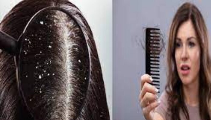 Hairfall and Dandruff Solution: മുടി കൊഴിച്ചിലും താരനും അകറ്റാം; ഈ ഒരൊറ്റ കാര്യം ചെയ്താൽ മതി