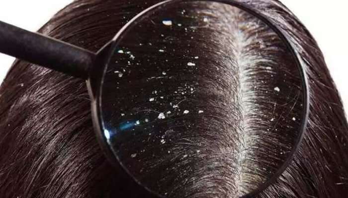 Dandruff Home Remedies: ആര്യവേപ്പ്, ഉലുവ, തൈര്; ഈ പൊടിക്കൈ മതി താരന്‍ പറപറക്കും 