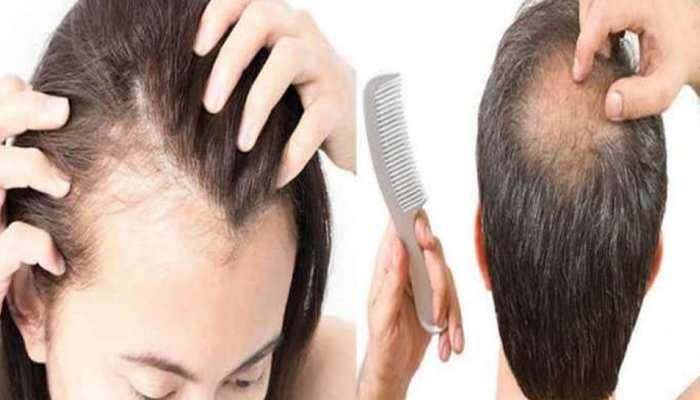 Hair Fall Reason: മുടി കൊഴിയുന്നതിന്‍റെ കാരണം അറിയാമോ? എങ്ങിനെ മുടി കൊഴിച്ചില്‍ തടയാം? 