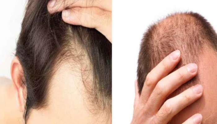 Oil for Hairfall: മുടി കൊഴിച്ചിലിനോട് പറയാം ബൈ ബൈ, ഈ എണ്ണകള്‍ പരീക്ഷിക്കൂ 